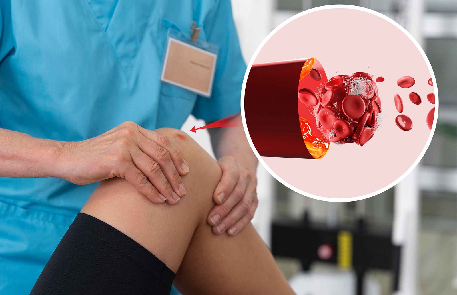 Treatment and Diet for Vericosity